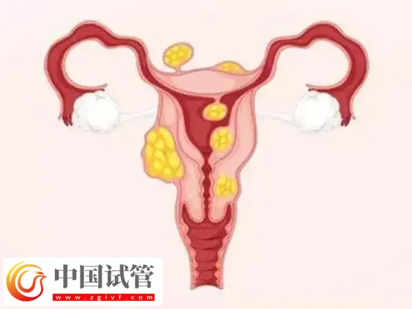 子宫肌瘤做试管婴儿注意事项有哪些(图1)