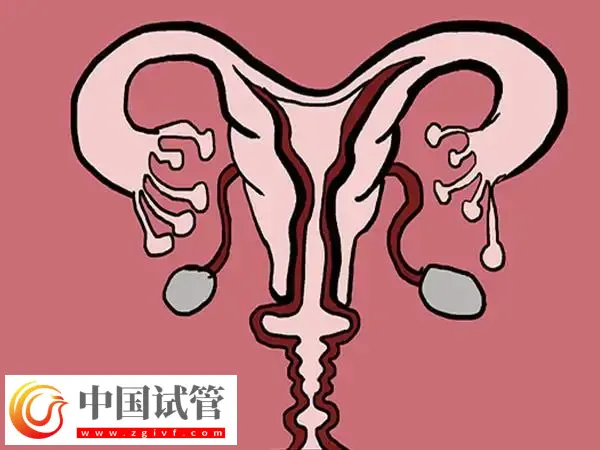 输卵管堵塞做试管婴儿成功率高不高(图1)