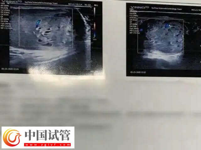 胚胎移植前如何调理内膜(图1)