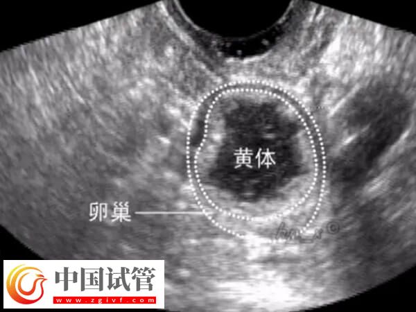 取卵后还有黄体残留怎么办(图1)