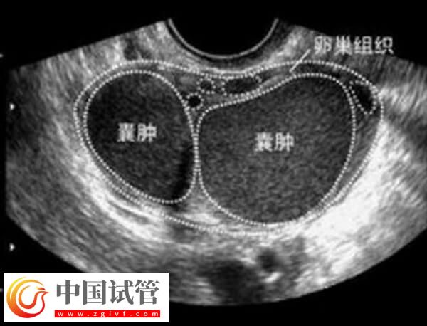 试管巧囊4cm影响着床(图1)