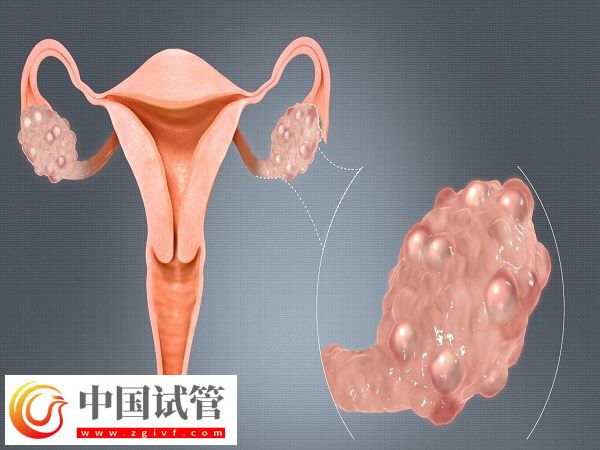 做试管输卵管积水有没有影响(图2)