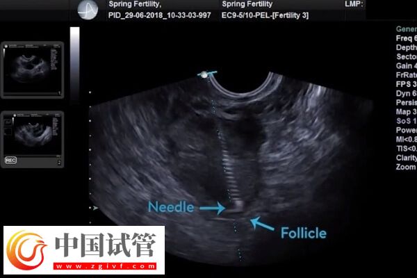 取卵后腹水怎么处理(图1)