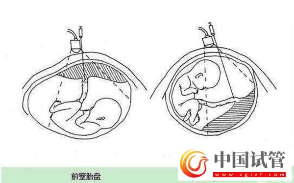 1分钟了解胎盘前壁和后壁的3大区别，为孕期做好准备(图1)