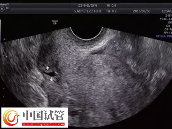 子宫憩室影不影响试管移植(图1)