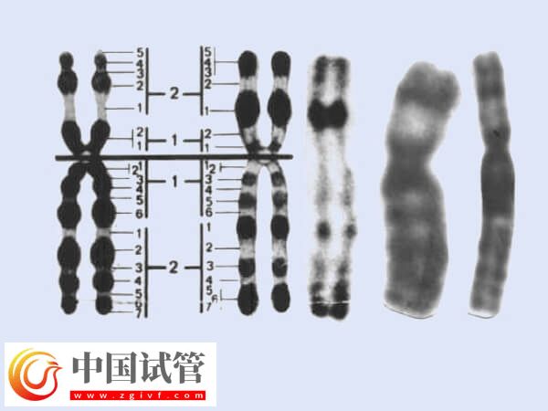 做试管2号染色体重复有什么影响(图2) 做试管2号染色体重复有什么影响(图1)