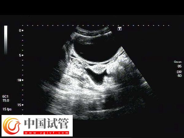 试管移植前子宫动脉阻力偏高打多久肝素(图2) 试管移植前子宫动脉阻力偏高打多久肝素(图2)