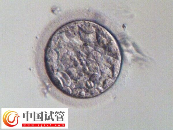 试管一次不成功二次移植费用多少(图3)