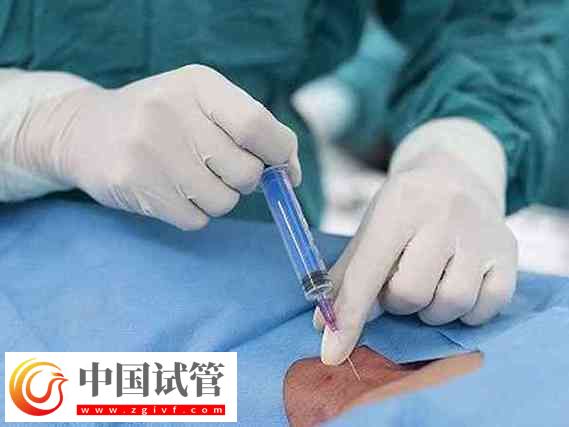 睾丸取精:试管婴儿的新希望(图1) 睾丸取精:试管婴儿的新希望(图1)