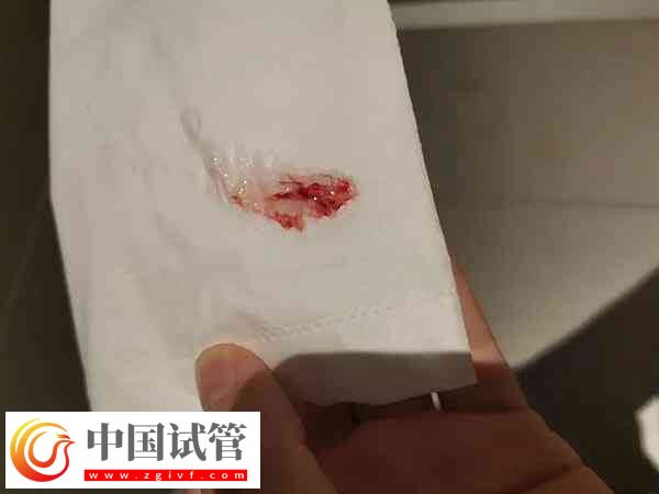 试管移植后有褐色血是不是生化了(图1) 试管移植后有褐色血是不是生化了(图1)