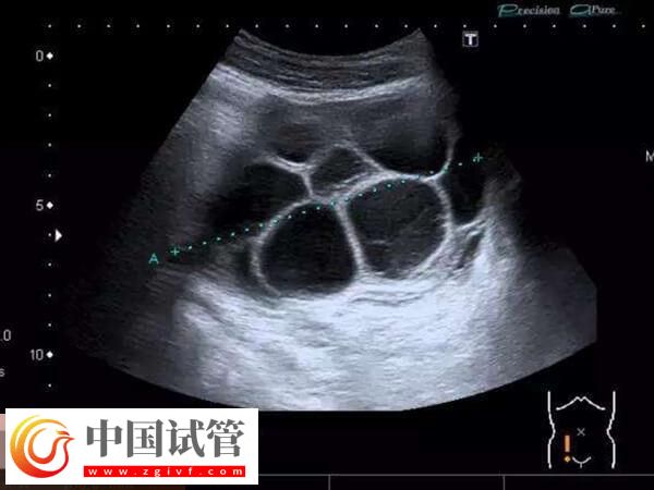 浅析移植完胚胎后为什么腹水,雌激素偏高或为主要因素(图1) 浅析移植完胚胎后为什么腹水,雌激素偏高或为主要因素(图1)