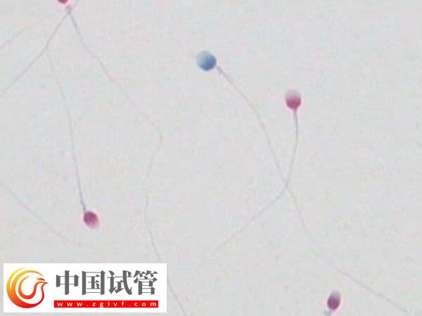 精子碎片报告是什么样的(图1) 精子碎片报告是什么样的(图1)