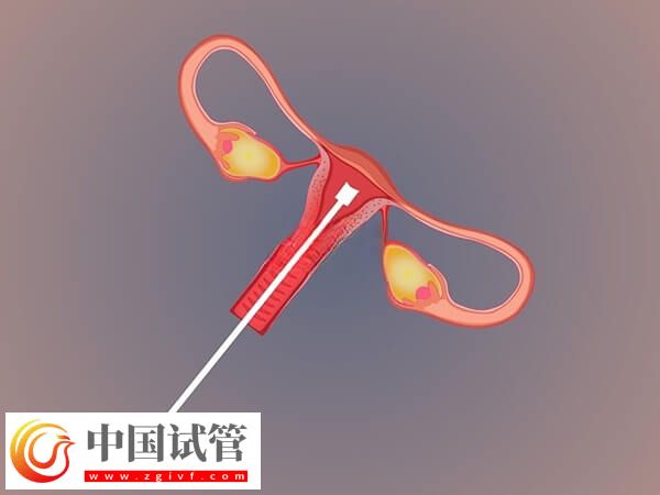 不经中介去泰国做试管要怎么做(图1)