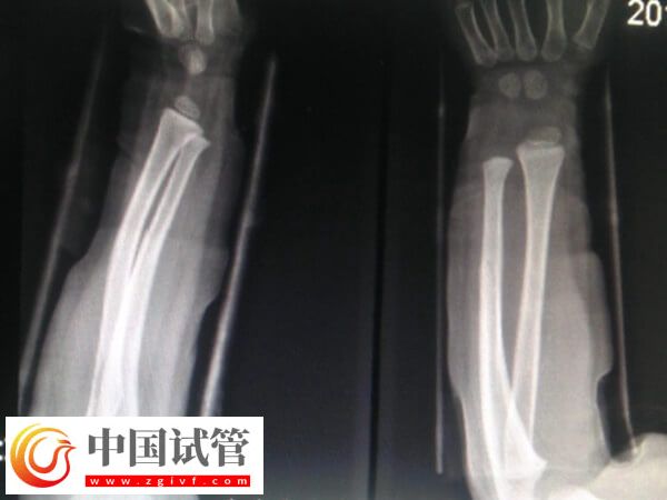 骨折愈合一年可不可以做试管(图2)