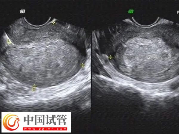 内膜移植窗口期一共查几次(图2)