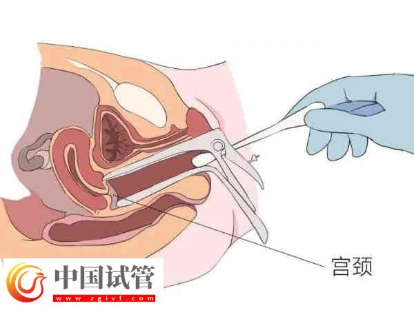 宫腔粘连是怎么引起的
