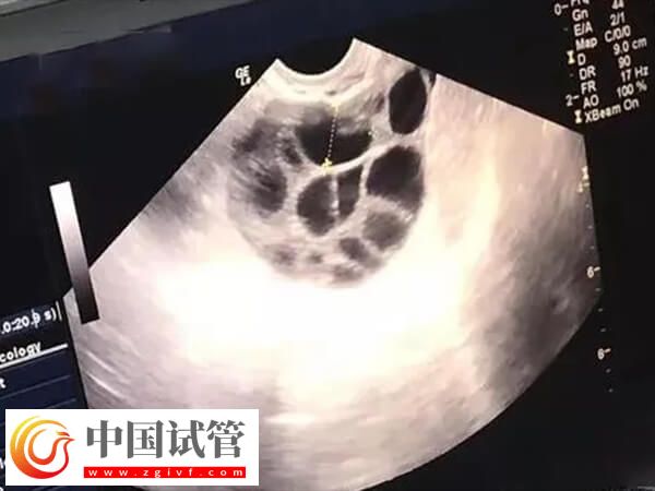 试管婴儿助孕有几个阶段(图2)