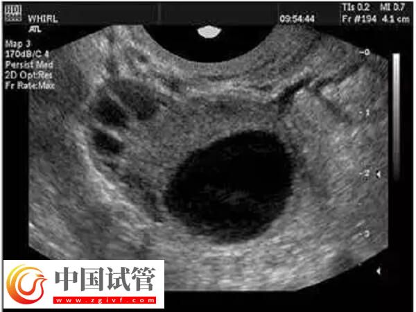 取卵为什么出现异形卵子(图1)