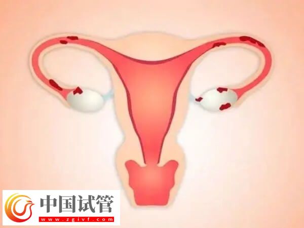 腔粘连不治会有什么后果