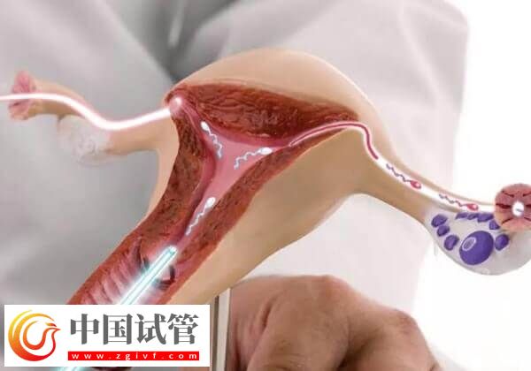 第四代试管婴儿适不适合大龄女性(图2)