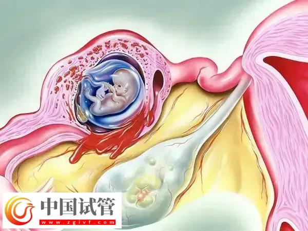 导致女性出现宫外孕的原因有哪些