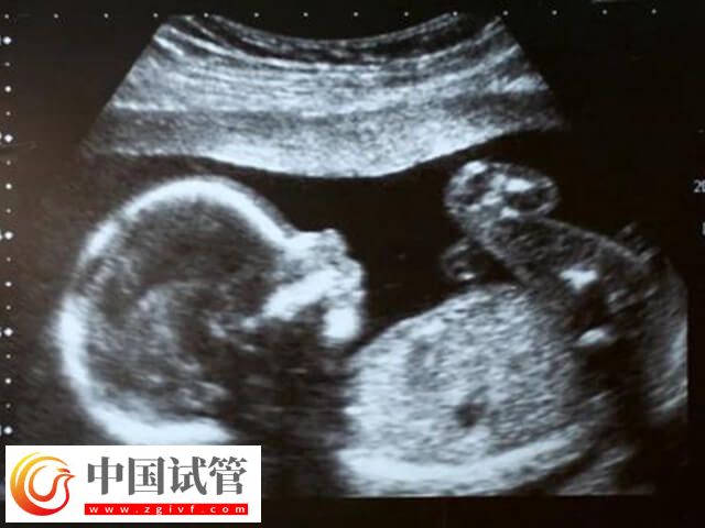 试管一超二超三超检查什么