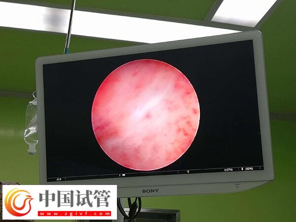 试管移植前内膜下降怎么回事